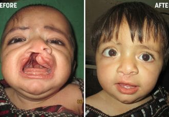 al mustafa welfare society cleft lip surgery